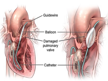 balloon-mitral