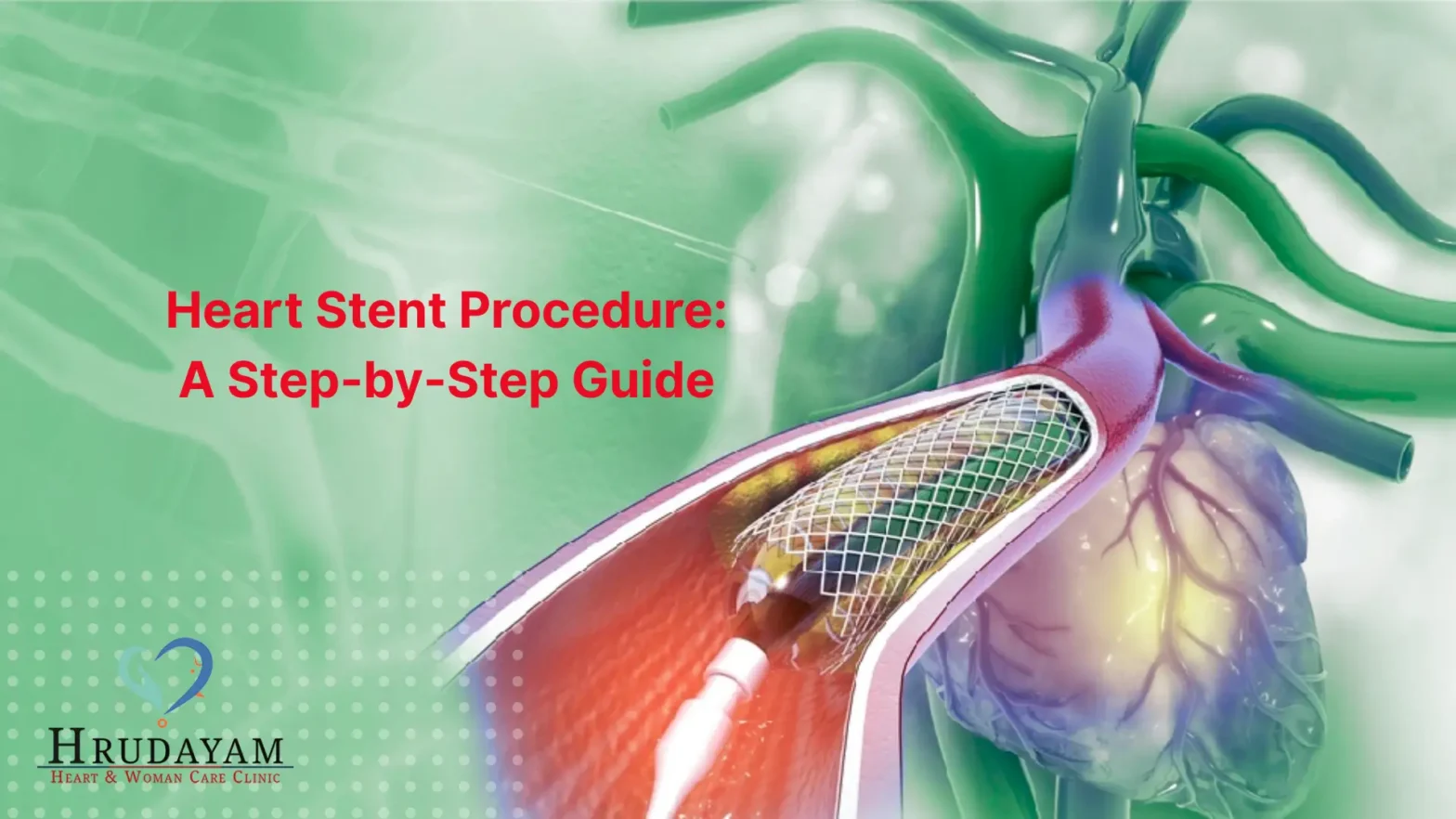 Heart Stent Procedure: A Step-by-Step Guide